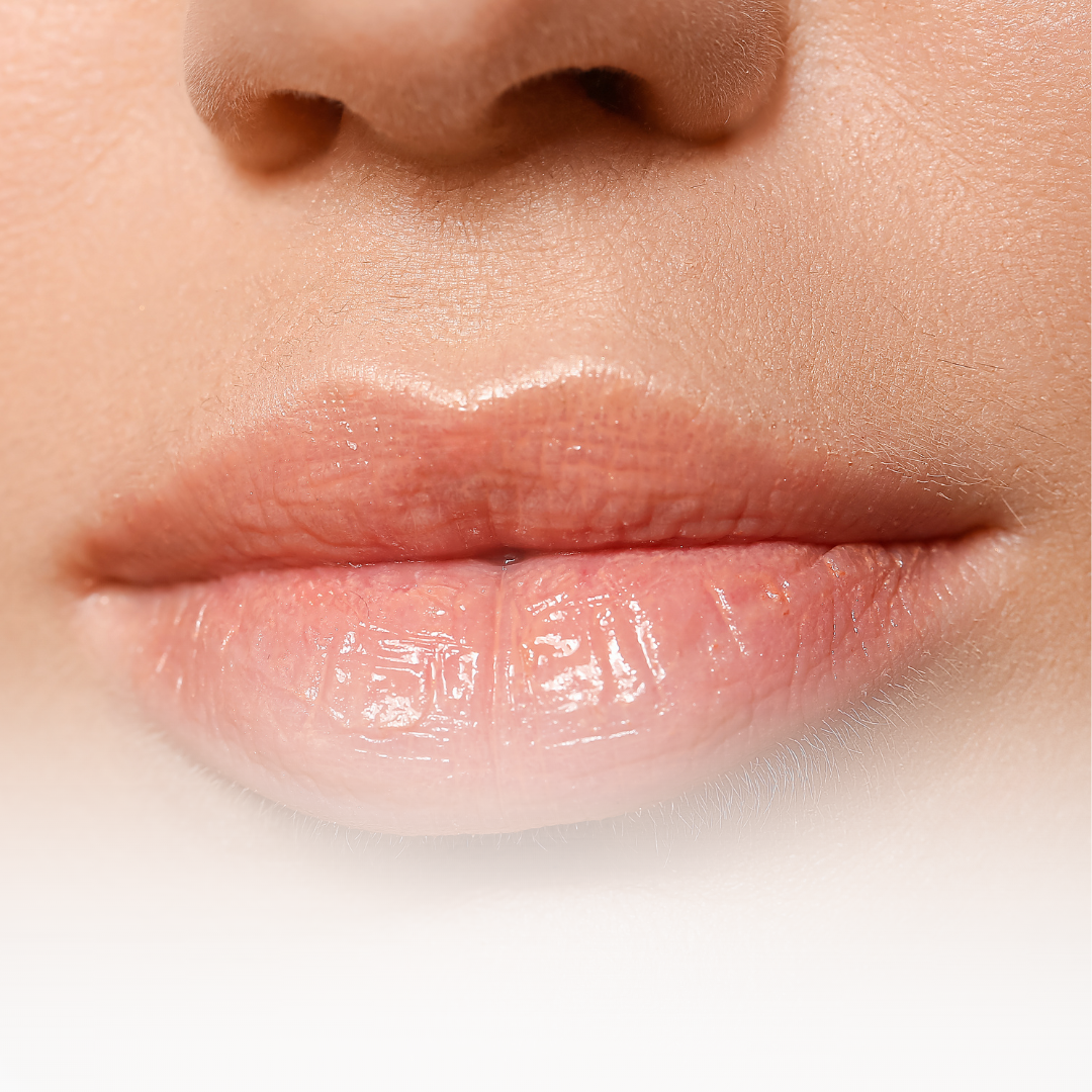 Ședință epilare definitivă - Mustață și bărbie